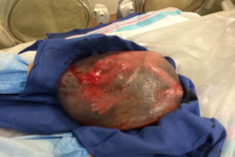 IRECÊ: Mãe dá à luz bebê em parto considerado raro